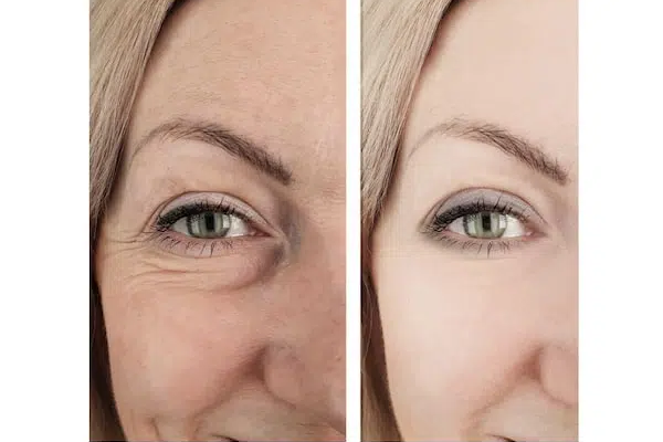 2- fillers