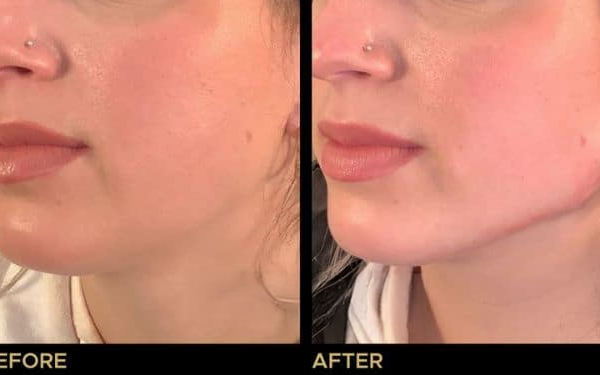 9- fillers
