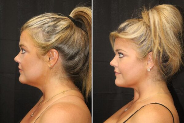 profile_view_ba_with_line