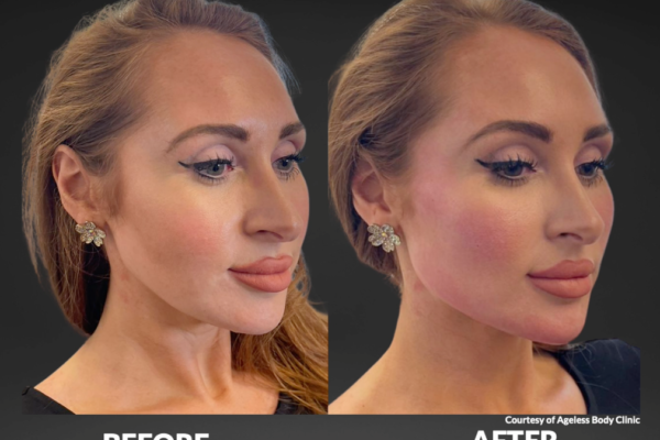 Cellenis Derma PRP Before and After - 2