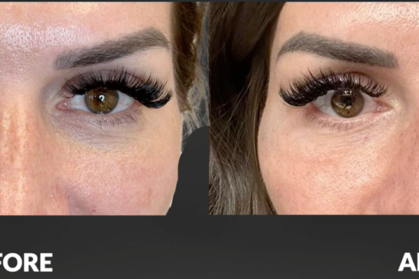Cellenis Derma PRP Before and After - 3