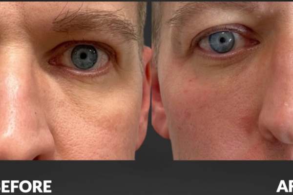 Cellenis Derma PRP Before and After - 4