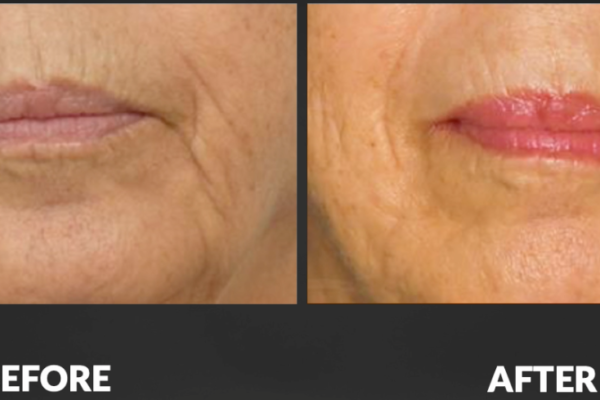Cellenis Derma PRP Before and After - 5