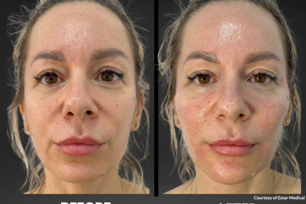 Cellenis Derma PRP Before and After - 6