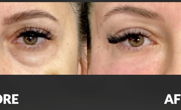 Cellenis Derma PRP Before and After - 7